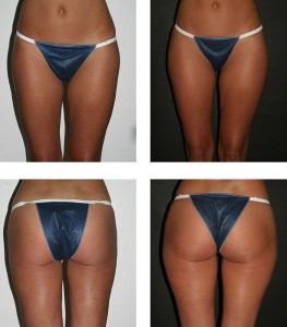 Liposuction result